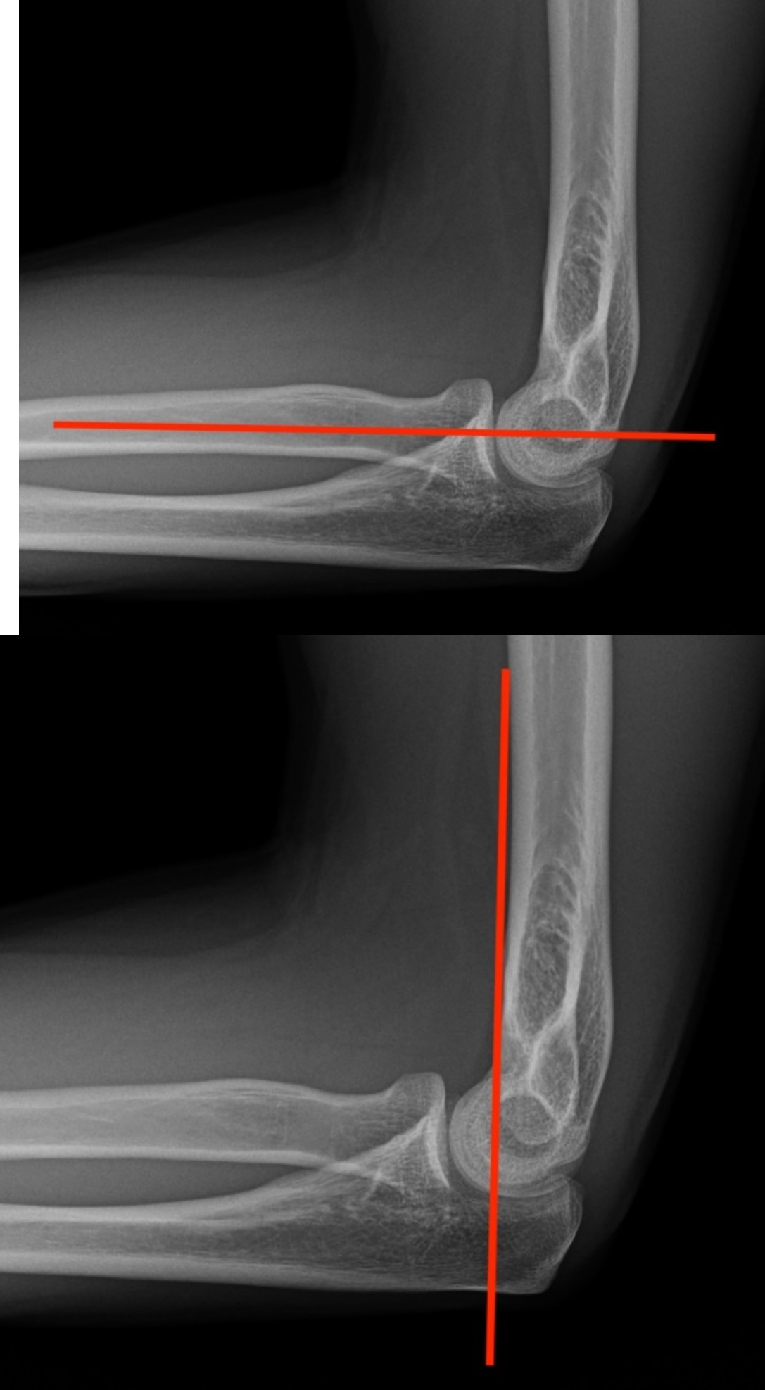 Traumatic Elbow Injury Radiology U of U School of Medicine